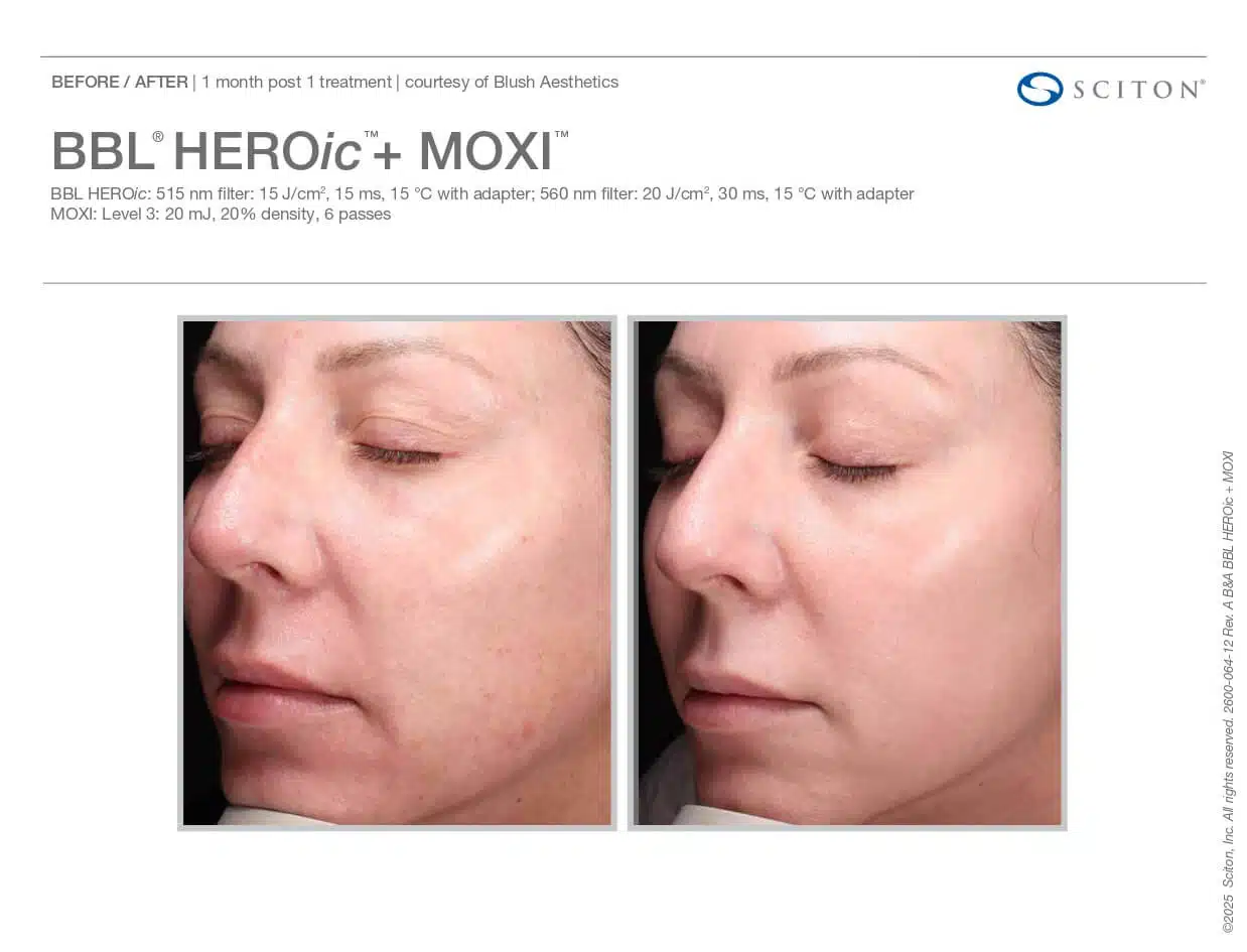 moxi before and after BBL woman side view