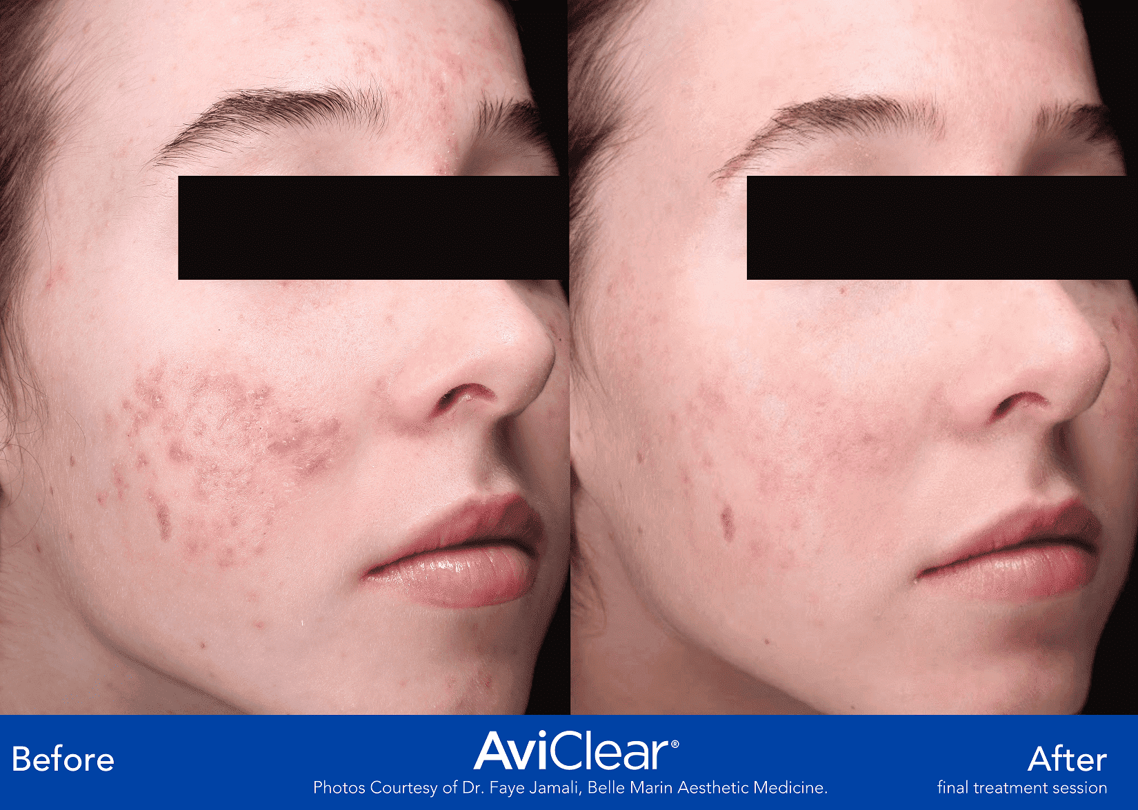 Aviclear before and after side profile woman