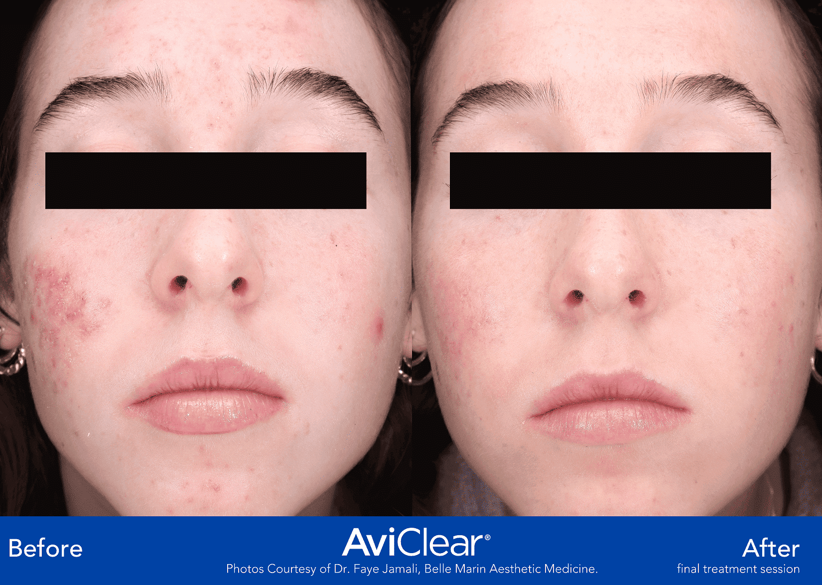 front profile Aviclear before and after