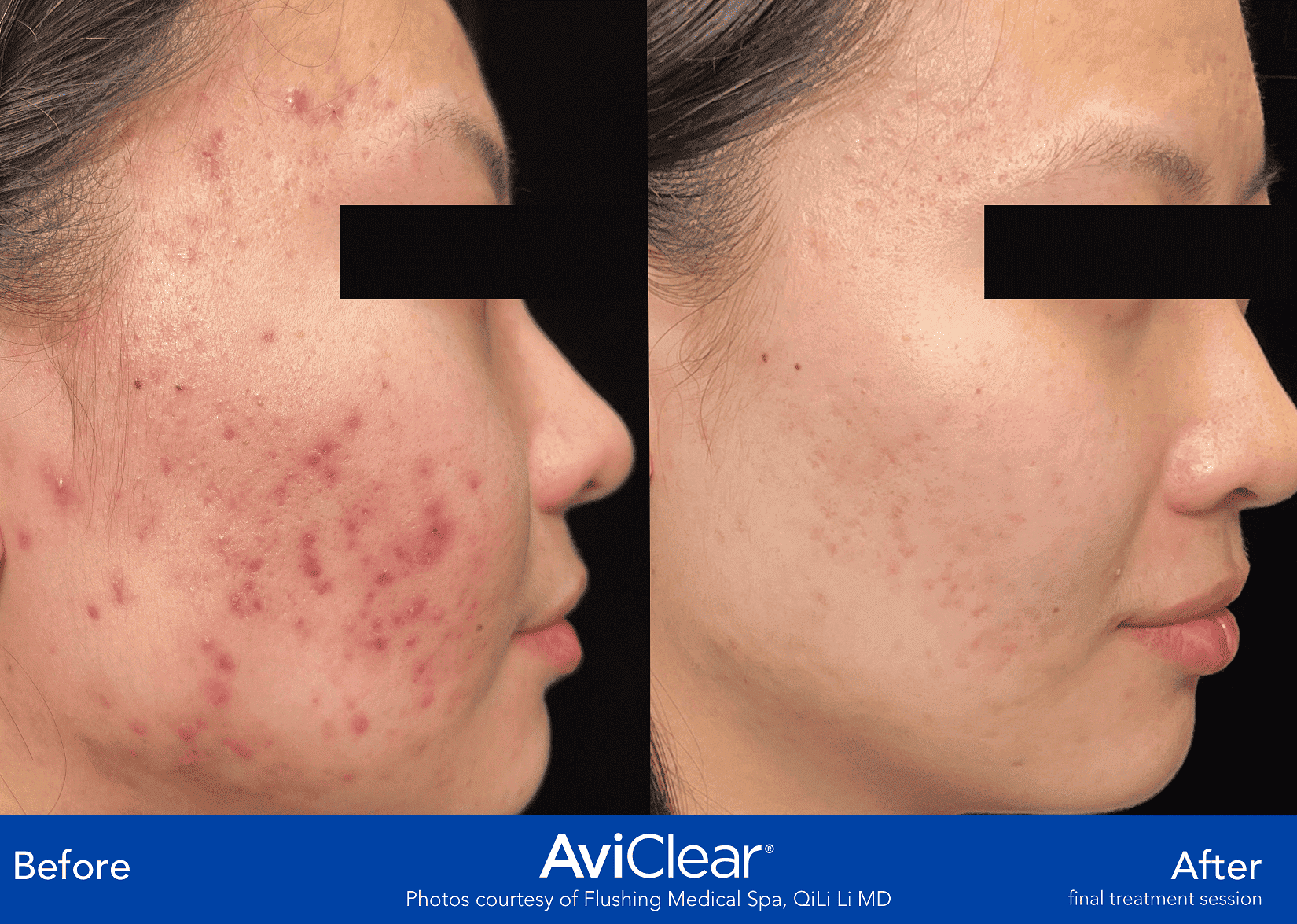 Aviclear before and after side profile woman