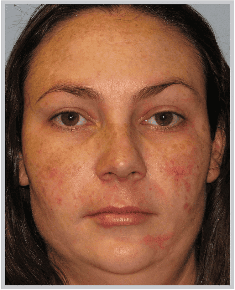 BBL light patient before