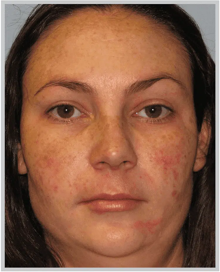 BBL light patient before