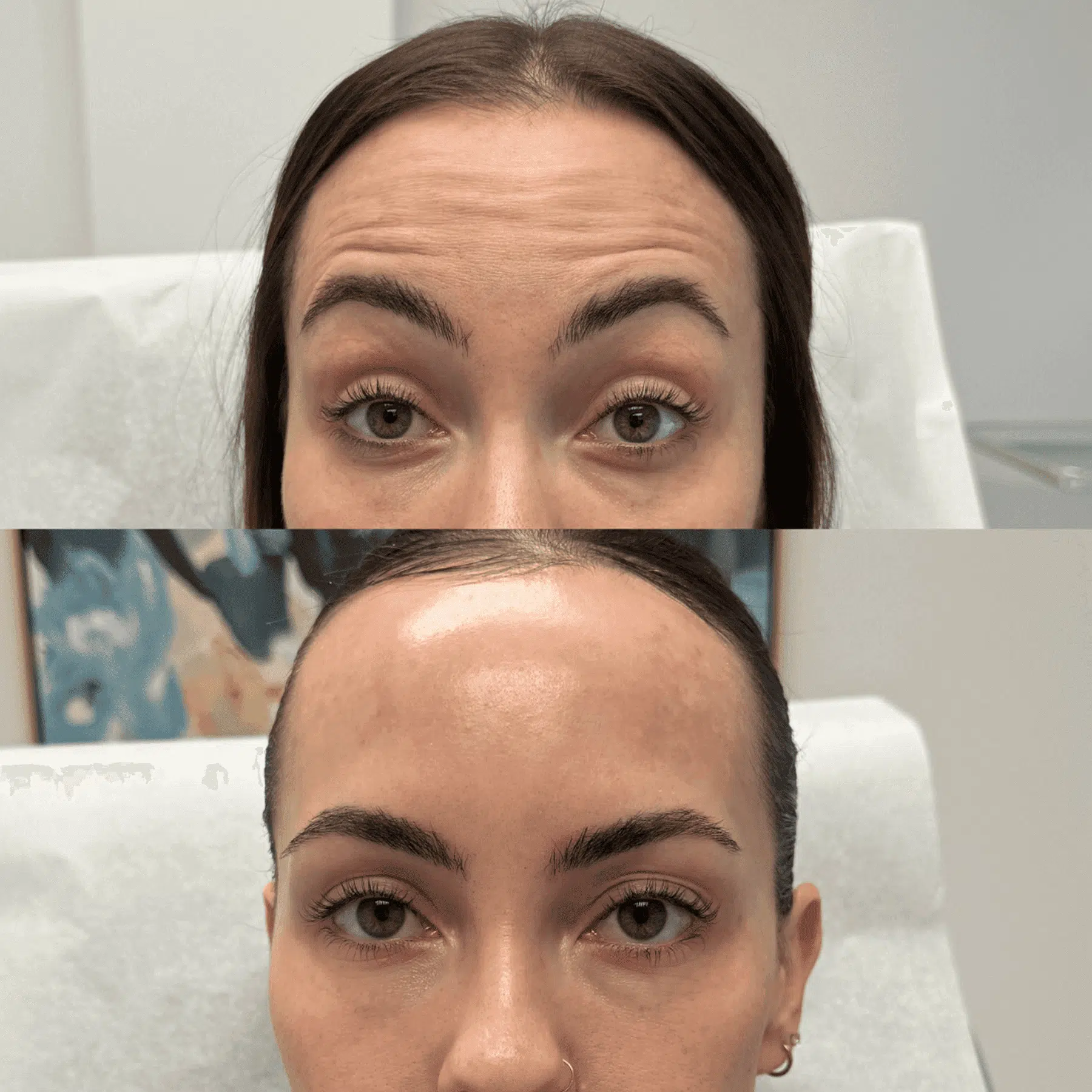 Woman before and after botox forehead