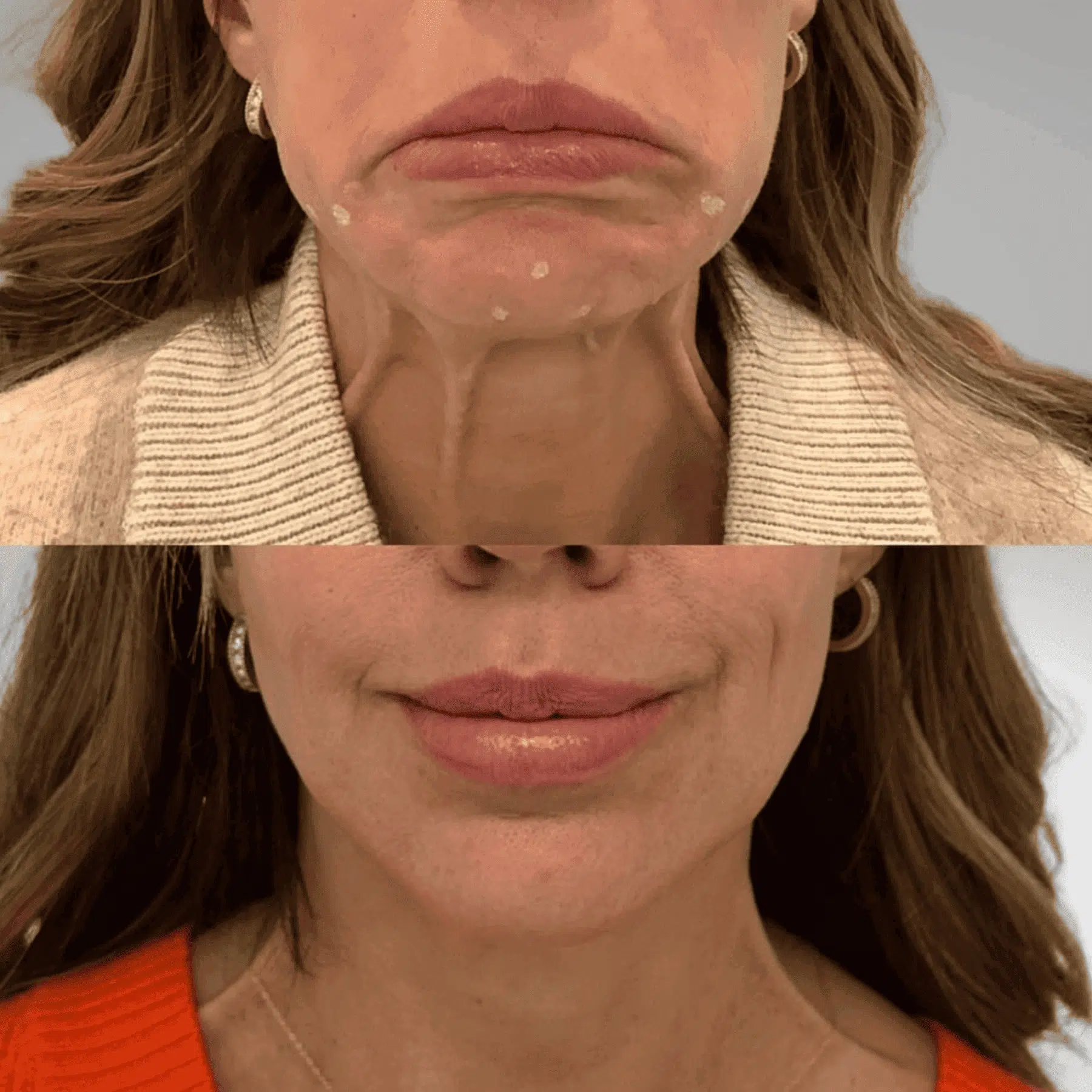 woman before and after botox lower face