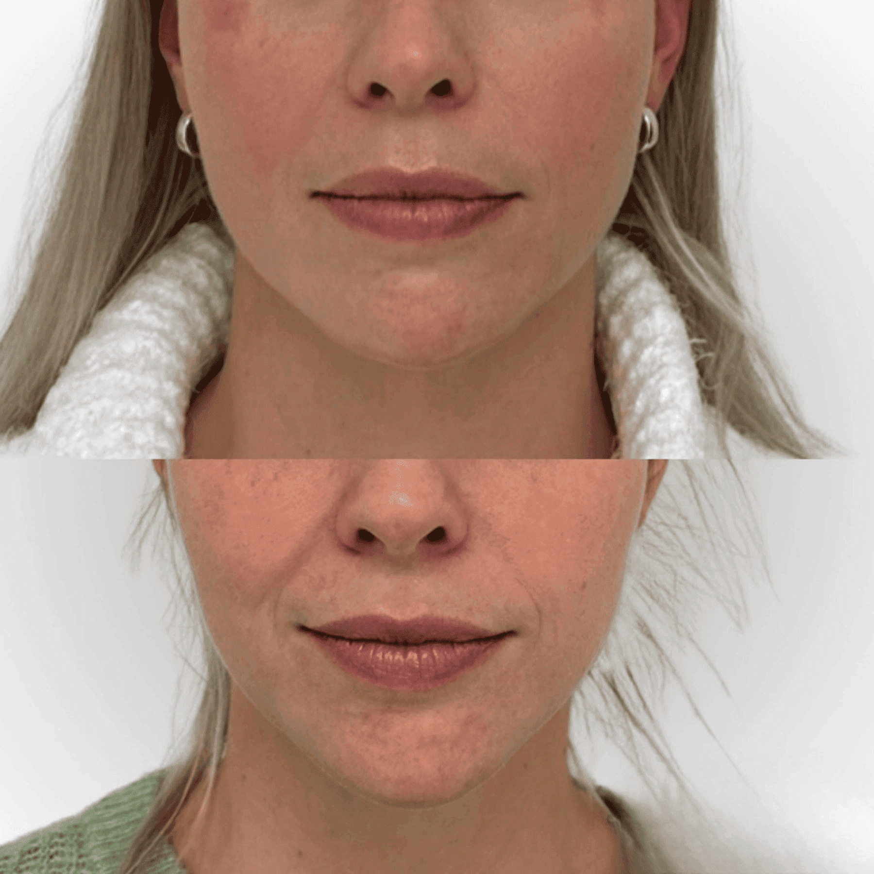 woman before and after botox lower face