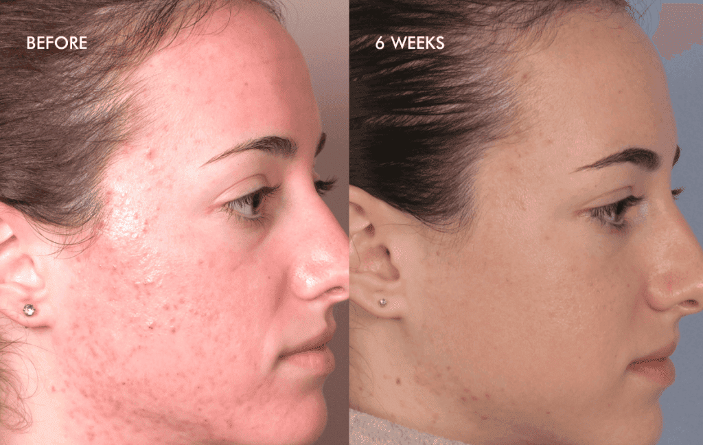Silkpeel treatment before and afters woman side profile