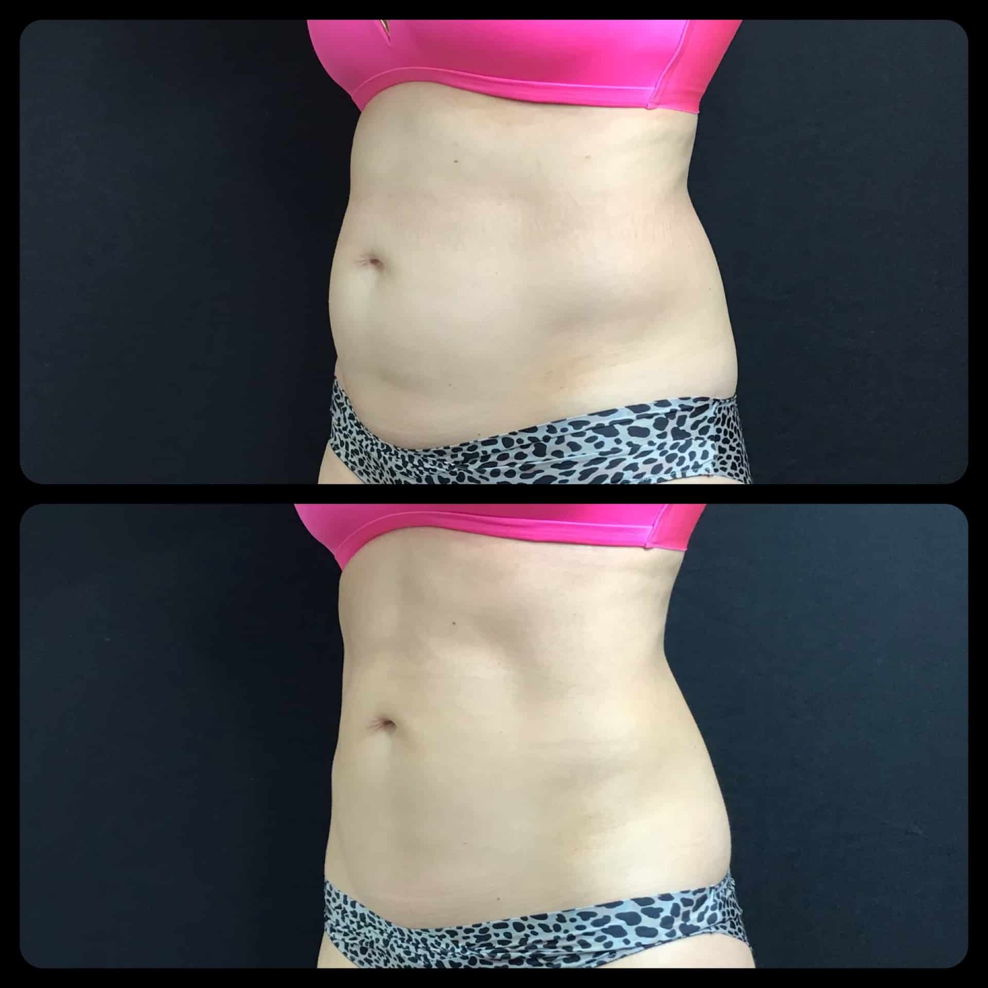 CoolSculpting Before and after side view GLO Antiaging