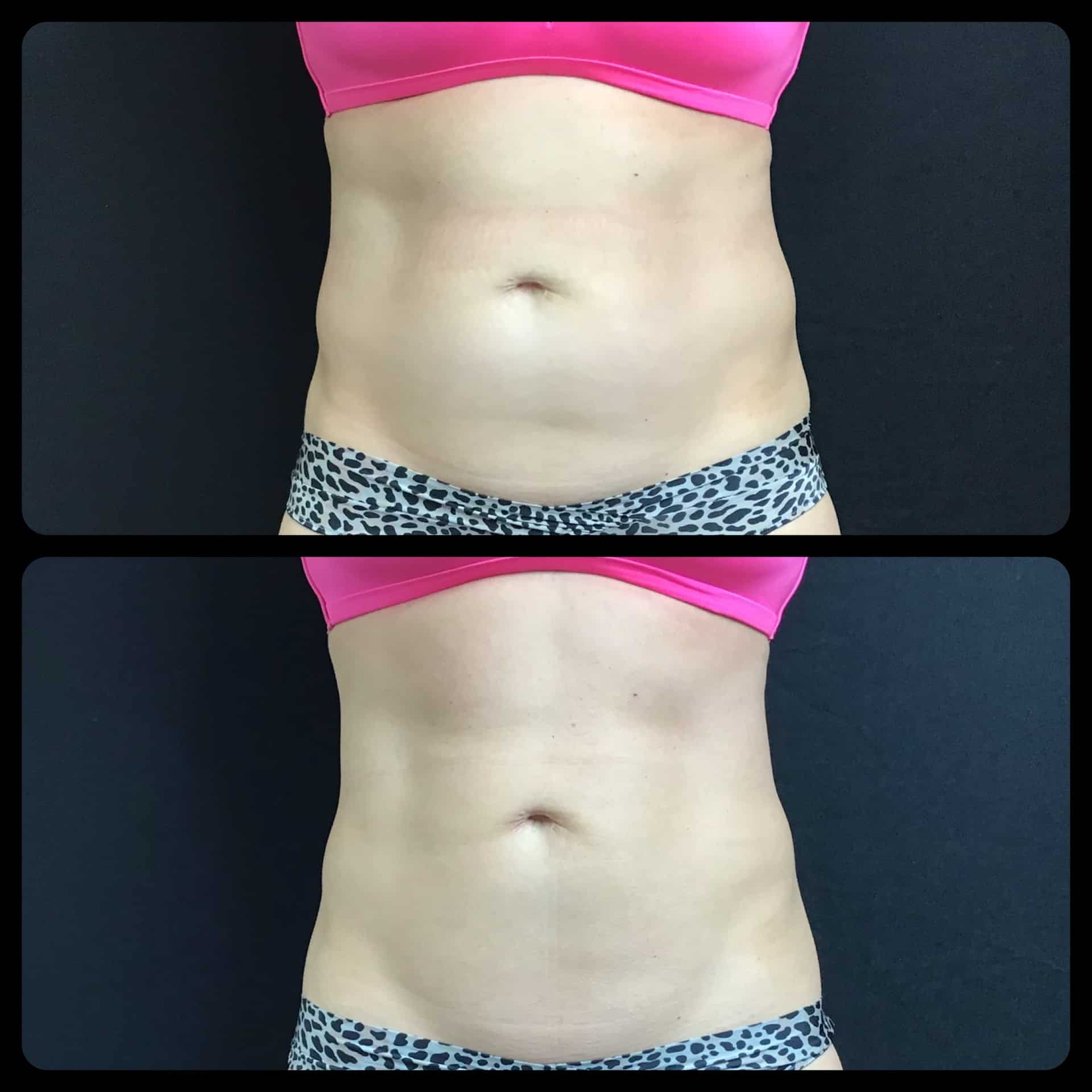 CoolSculpting Before and after GLO Antiaging Front fiew