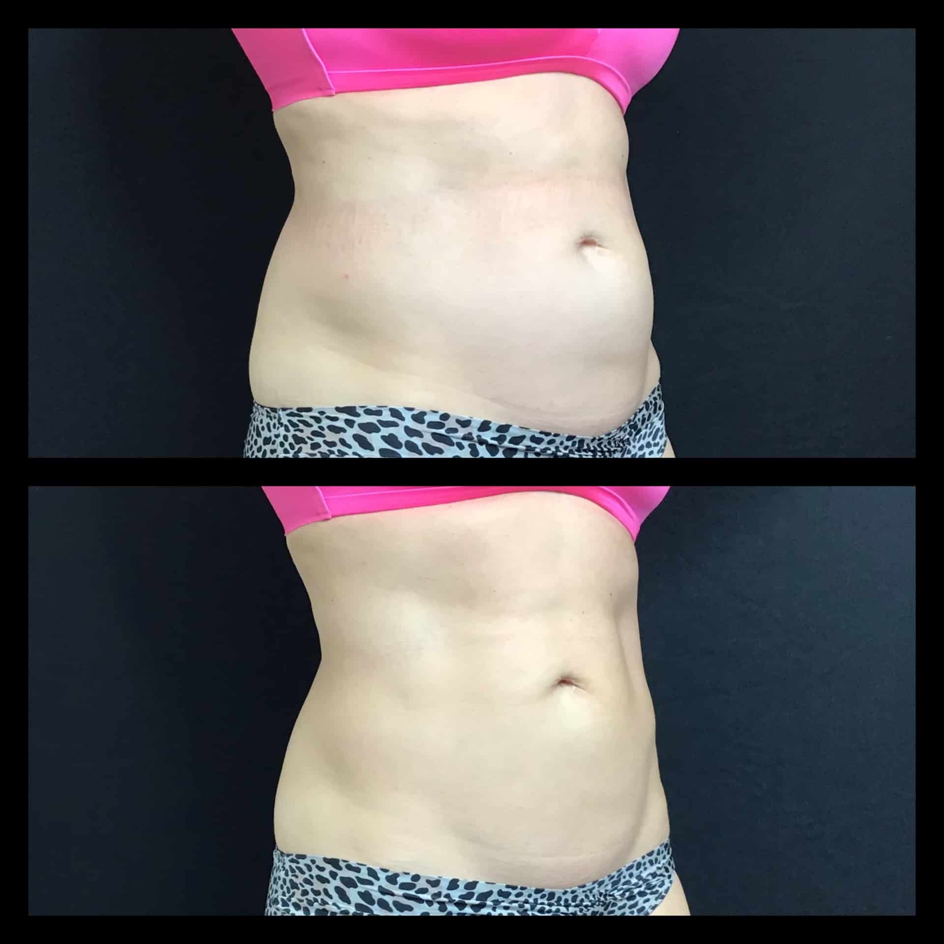 CoolSculpting Before and after GLO Antiaging