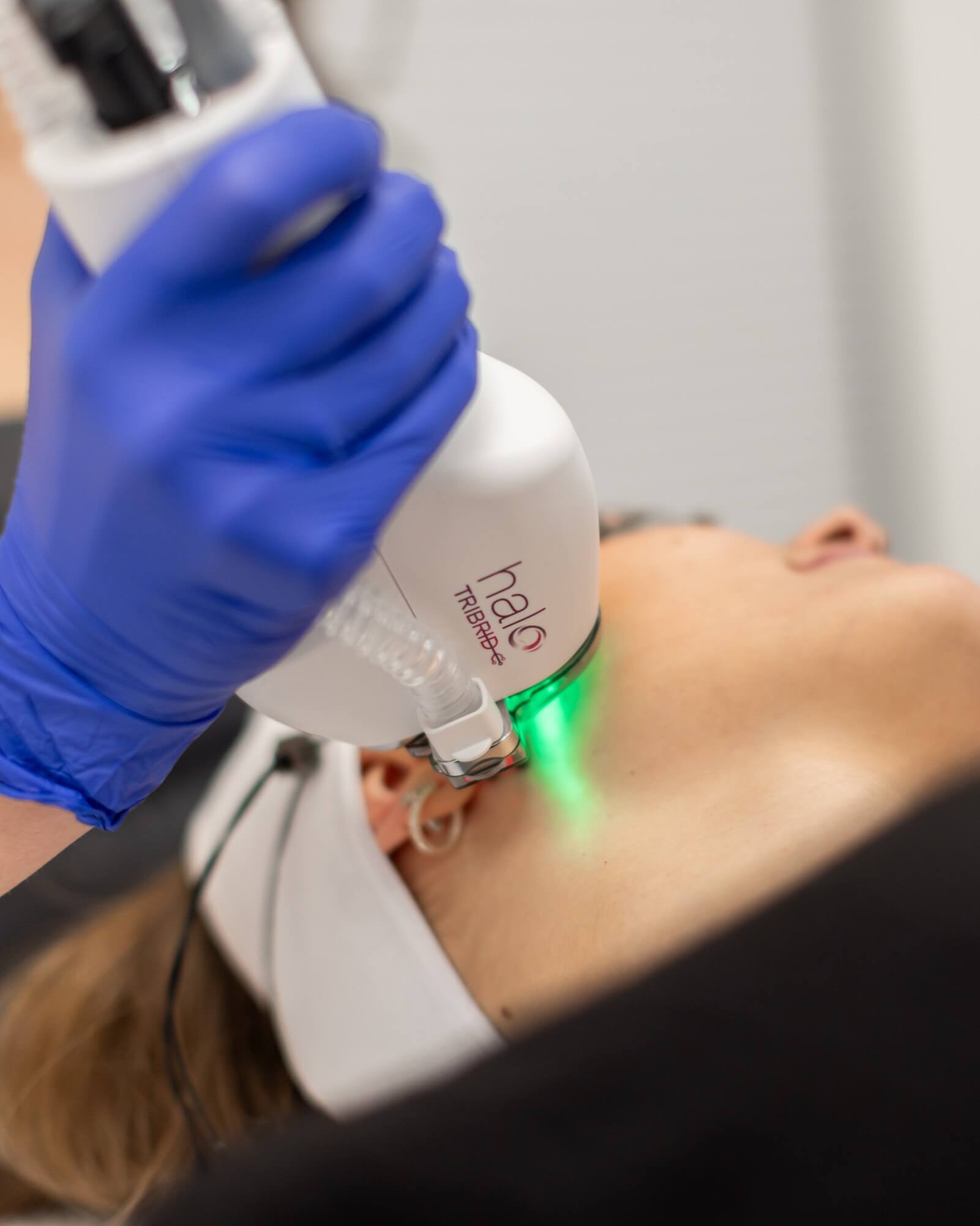 HALO TRIBRID™ Laser Treatment in Calgary