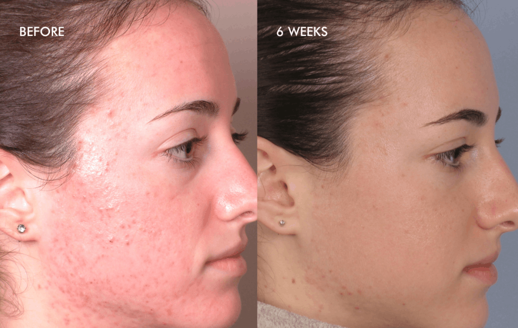 Silk peel acne before and after GLO