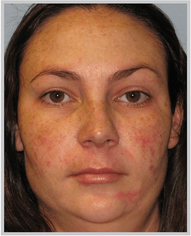 BBL light antiaging facial before GLO